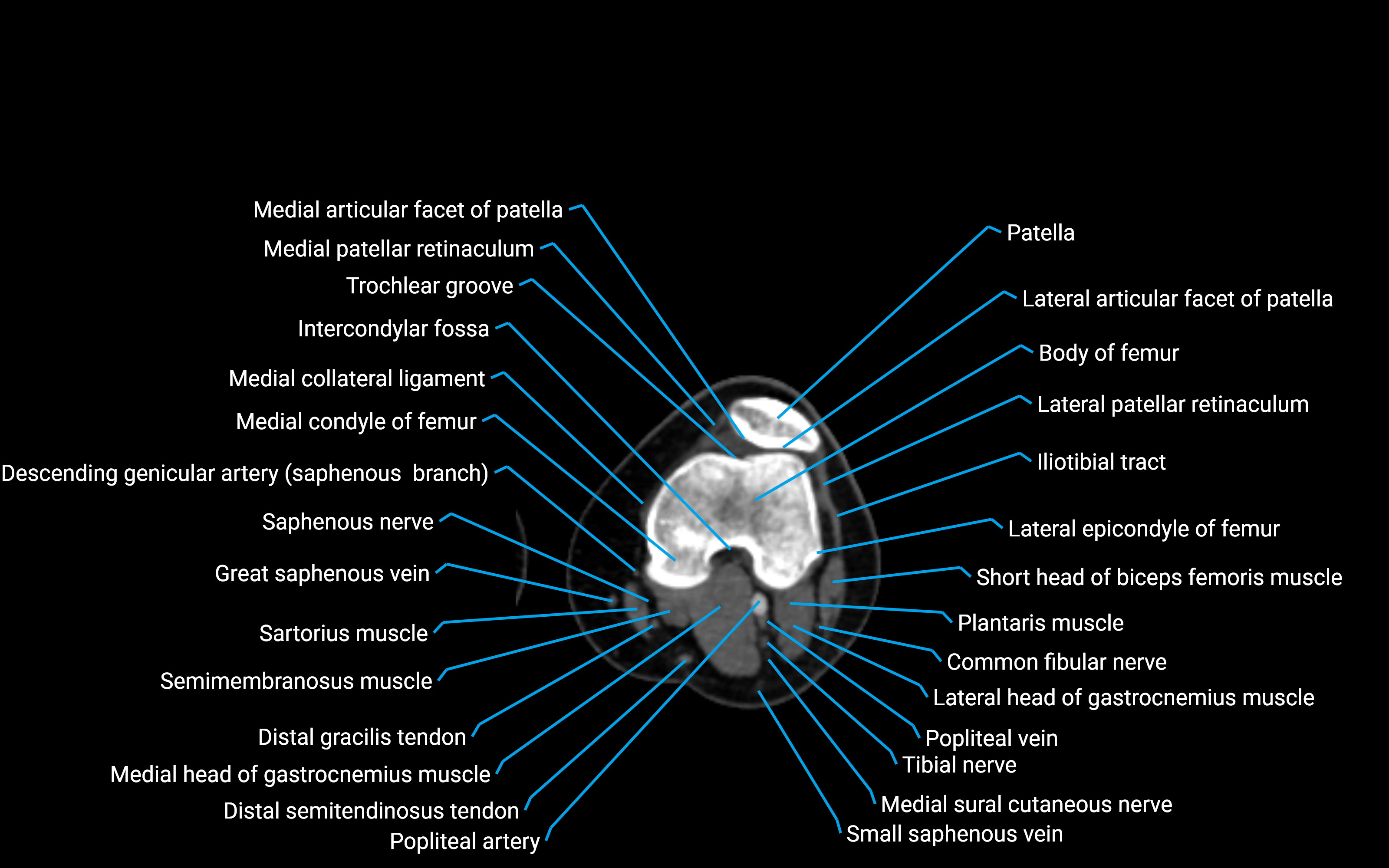 CT Lower leg axial cross sectional anatomy labelled image 84 (2).png